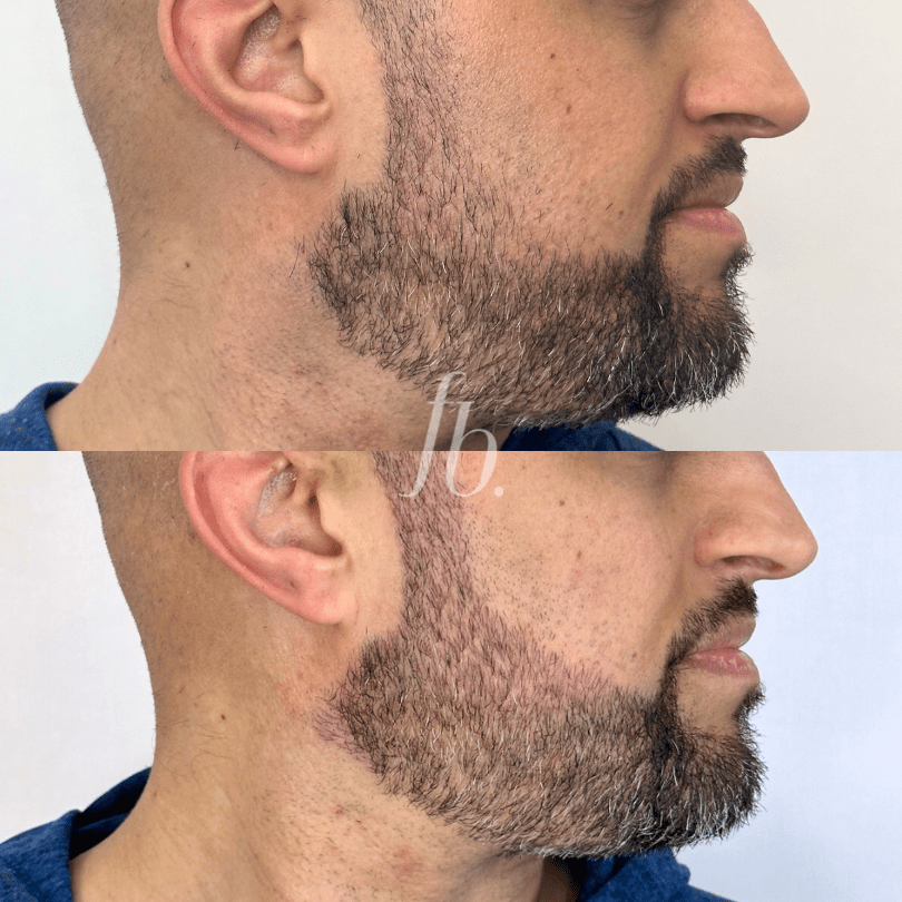 curso online nanoblading de barba fran boscaini 2 min