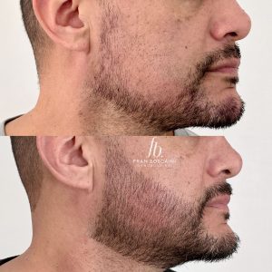 micro barba homem porto alegre nanoblading fran boscaini 1 scaled