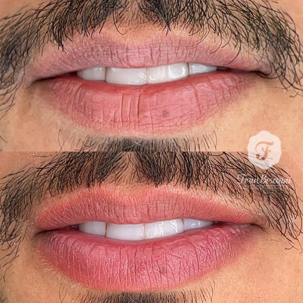 micro-labial-homens-porto-alegre