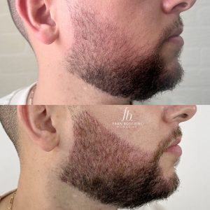 preenchimento de barba fran boscaini curso online micropigmentacao 3 min scaled