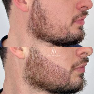 preenchimento de barba fran boscaini curso online micropigmentacao 4 min scaled qg4cs360rl5yycsbcofr5aa92fbalbfda17ay5smns