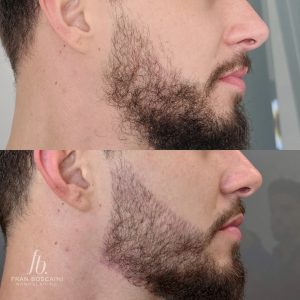 preenchimento de barba fran boscaini curso online micropigmentacao 5 min scaled